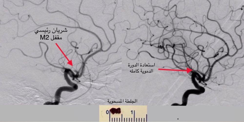 في أقل من 30 دقيقة .. إنقاذ حياة حاجة عراقية من جلطة دماغيه