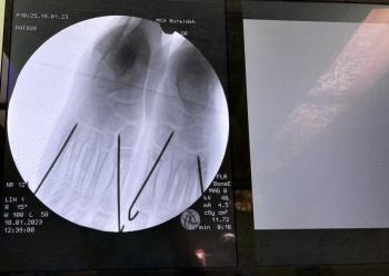 في القصيم.. جراحة تصحيحية عاجلة تُمكّن طفلة من المشي