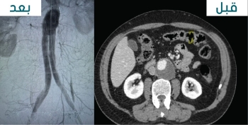 نجاح عملية إصلاح تمدد الشريان الأورطي البطني لمريض يبلغ من العمر 69 عامًا